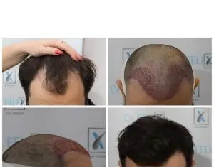 Implant de păr de calitate cu plata în rate la Dr. Felix Hair Implant!