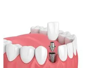 Servicii transparente de implant dentar, la Clinica Dental Premier din Bucuresti