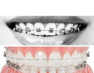 Cat costa un aparat dentar si care este pretul corect?