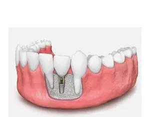 Aditia de os sau augmentarea osoasa pentru implant dentar