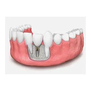 aditia-de-os-dentar-in-vederea-implantului-dentar.jpg