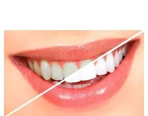 Albirea dintilor prin tehnici ultraperformante la clinica stomatologica Dental Premier