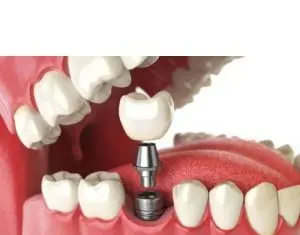 Unde poate fi realizat un implant dentar de calitate?