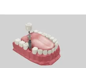 Cele mai frecvente întrebări despre implantul dentar