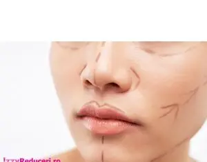 Lifting facial nechirurgical cu Fire resorbabile PDO